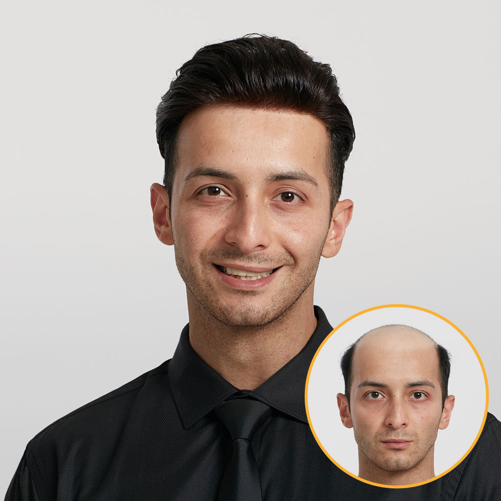 HS25V 0.03mm Ultra Thin Skin Hair System with V-Loops All Over (7)