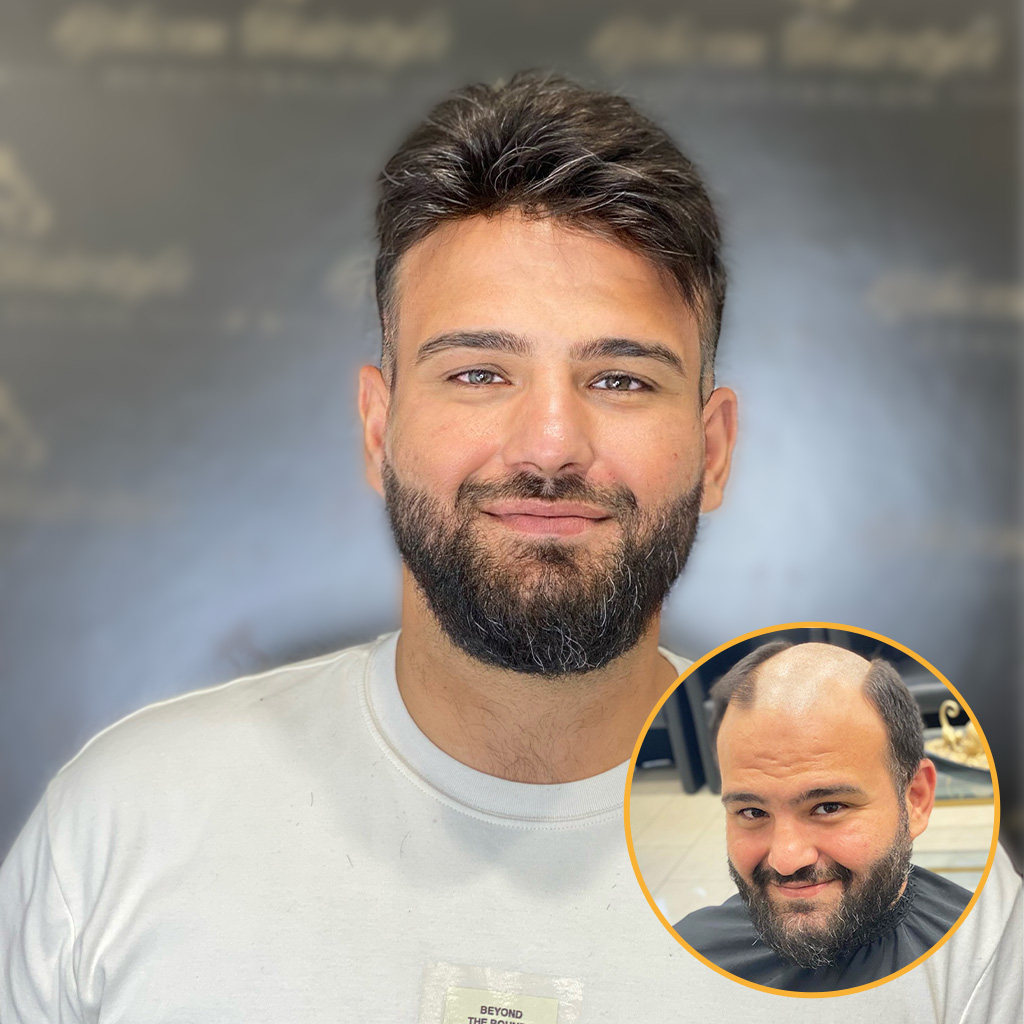 Realistic 0.08 mm Thin Skin Toupee for Men Wholesale Discount, image size:1024x1024