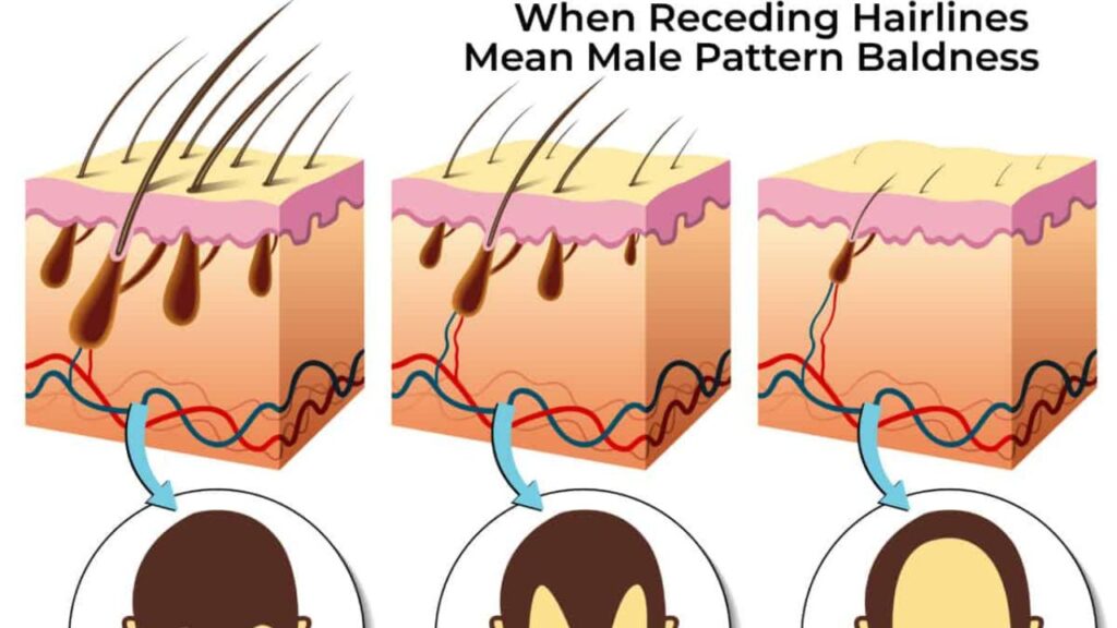 Male pattern baldness
