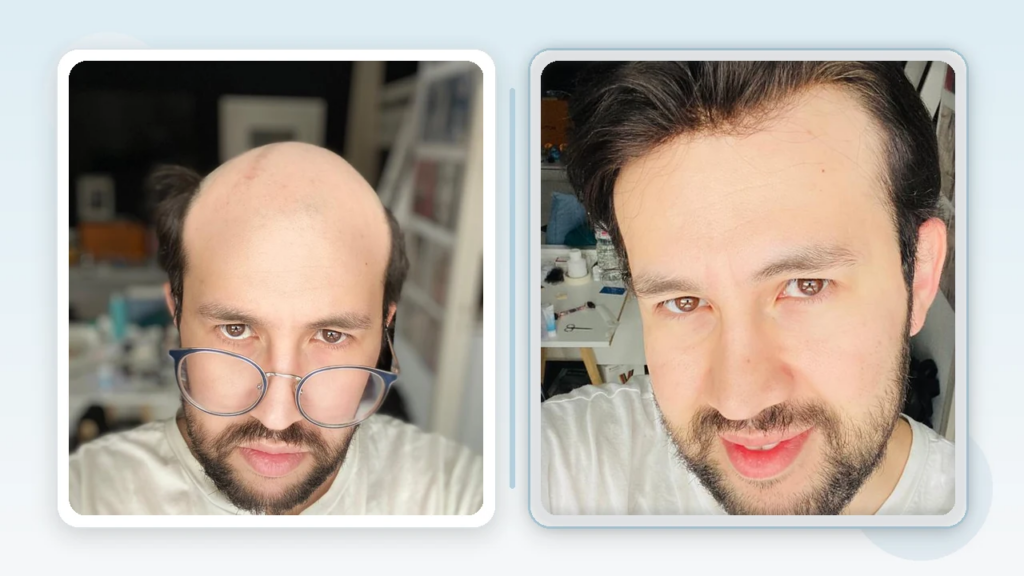Hollywood hair system before and after